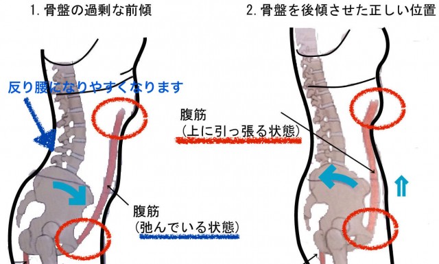 反り腰改善メカニズム最新